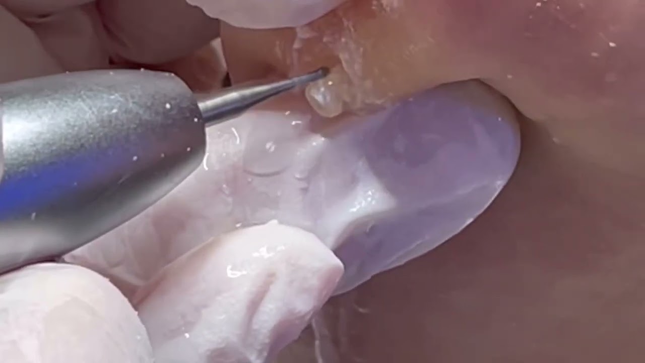 どデカい魚の目が取れた瞬間映像🦶世田谷区用賀フットケア＃魚の目＃鶏眼