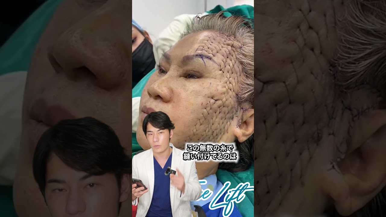 整形失敗...? やばいフェイスリフト #shorts